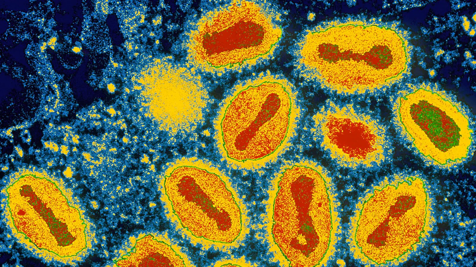 Bệnh đậu mùa là bệnh gì?